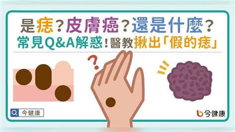 身體痣的好壞|是痣？皮膚癌？還是什麼？常見Q&A解惑！醫教揪出「。